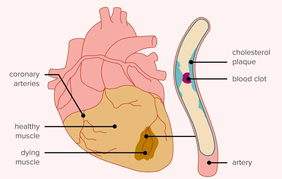 Heart Attack & Heart Failure Treatment In Pune