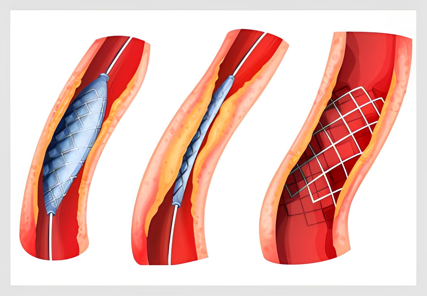 Chest Pain & Pacemaker Treatment in Pune