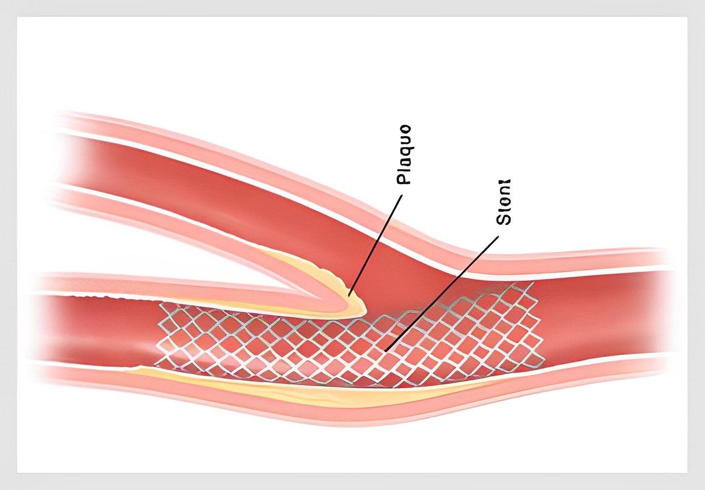 Heart Attack & Heart Failure Treatment In Pune