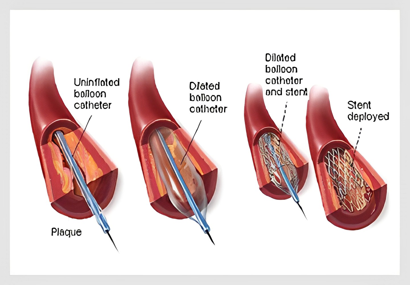 Congenital Heart Disease in Children